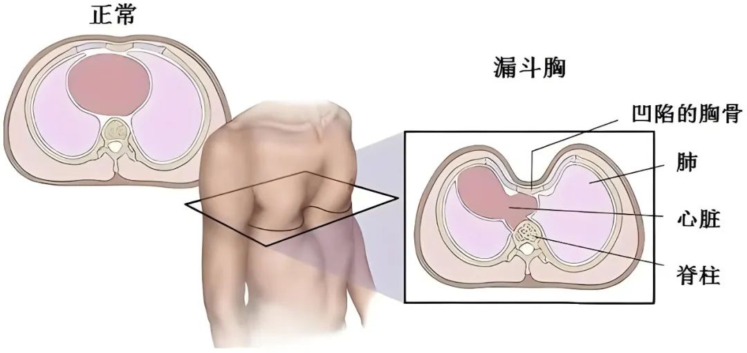 家长快自查：孩子胸前有「漏斗」吗？