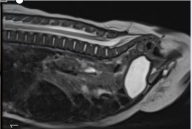 宝宝腰上的「小洞」，竟是致命「皮毛窦」