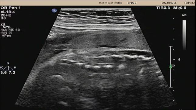 宝宝腰上的「小洞」，竟是致命「皮毛窦」