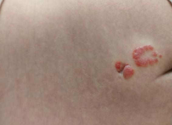 宝宝腰上的「小洞」，竟是致命「皮毛窦」