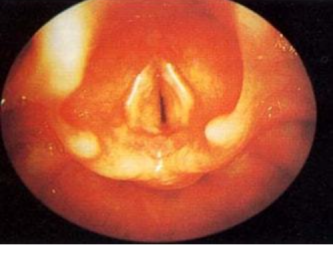 以为是感冒,没想到要命!当心这种「锁喉功」