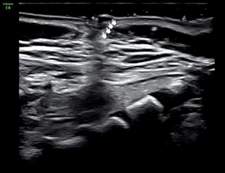 宝宝腰上的「小洞」，竟是致命「皮毛窦」