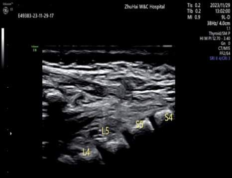 宝宝腰上的「小洞」，竟是致命「皮毛窦」