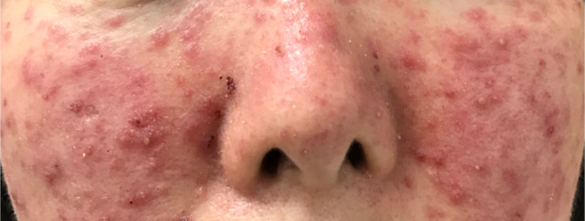 脸红≠敏感肌,带你正确认识玫瑰痤疮