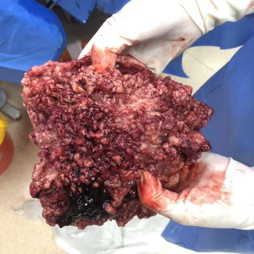 月经不规则，需警惕癌变！