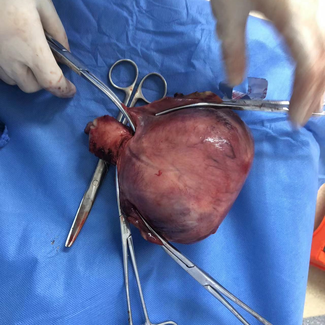 月经不规则，需警惕癌变！