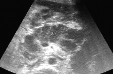 超声认识小儿腹痛——小儿急性胰腺炎