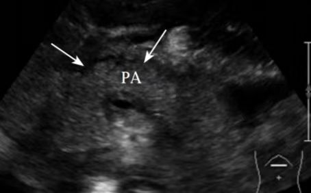 超声认识小儿腹痛——小儿急性胰腺炎