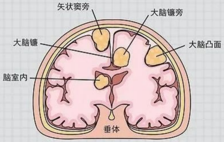 92 岁，巨大脑肿瘤！