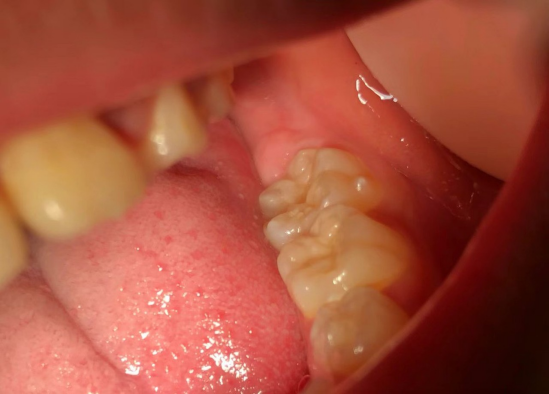 做完窝沟封闭是不是就不会再有龋齿了？