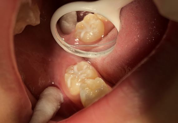 做完窝沟封闭是不是就不会再有龋齿了？