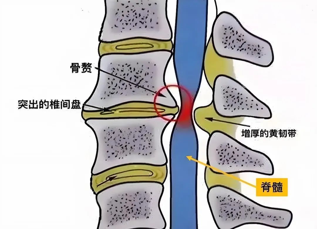 苏州京东方医院骨二科团队成功治疗一例脊髓型颈椎病患者