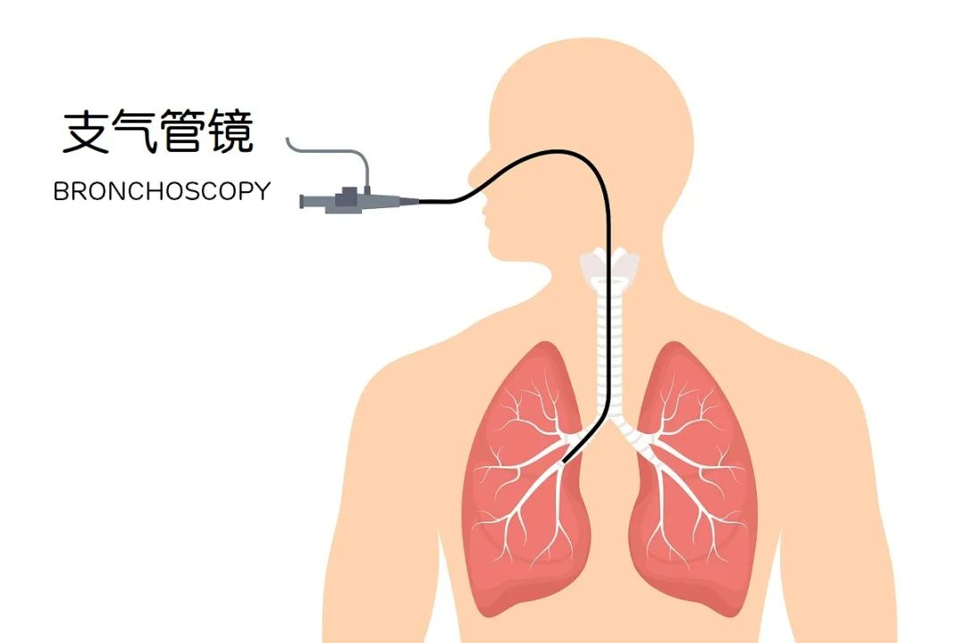 肺腺癌切除时仍是零期，魔术师刘谦是怎么办到的？​