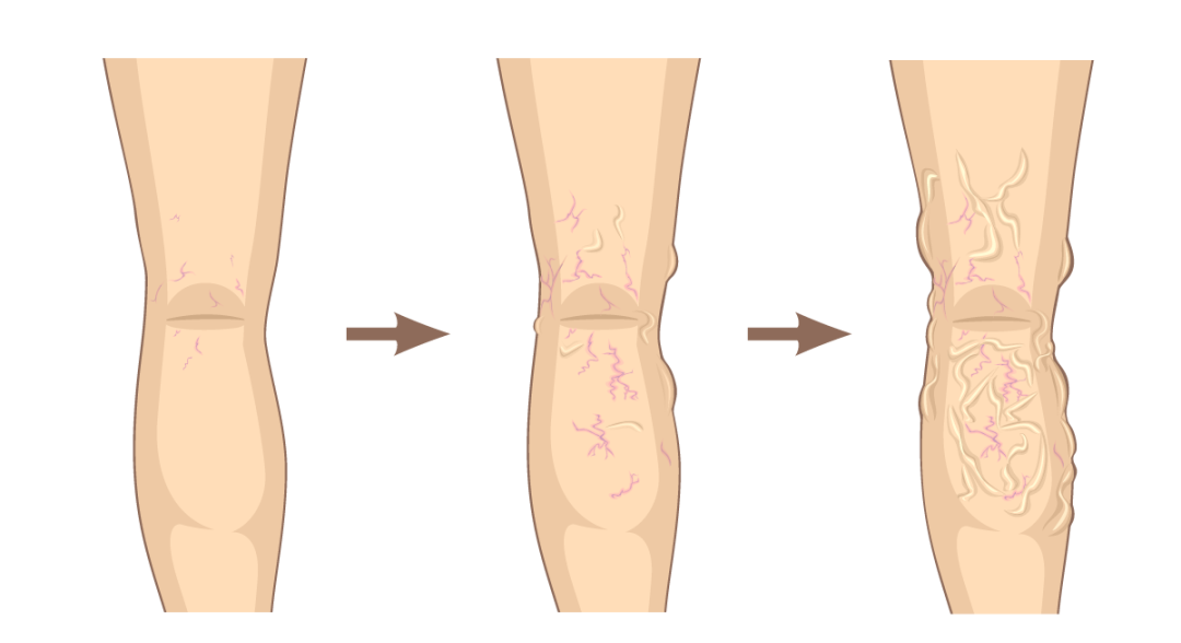 这种「蚯蚓」影响生育  男性要重视