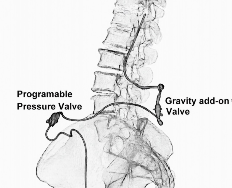 不开颅!新「渠道」治疗脑积水