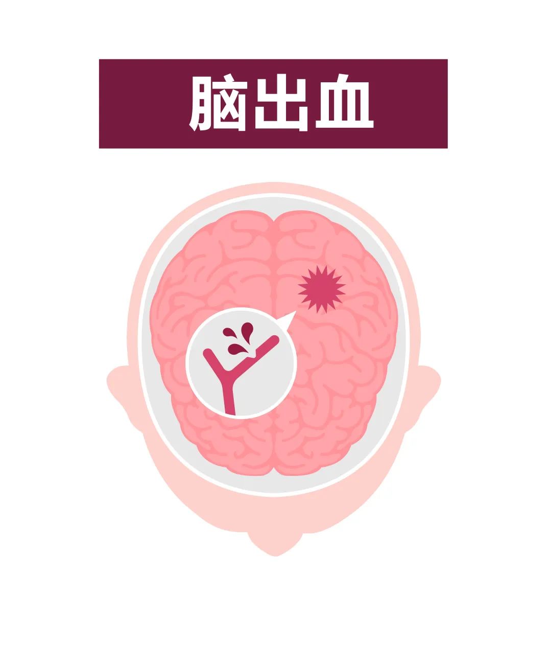 官宣!苏州京东方医院入围苏州市卒中地图医院