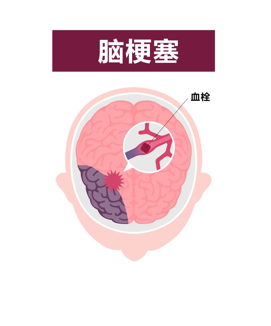 官宣!苏州京东方医院入围苏州市卒中地图医院