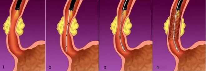 食管支架  解 90 岁老人难「咽」之隐