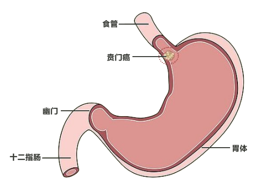 食管支架  解 90 岁老人难「咽」之隐