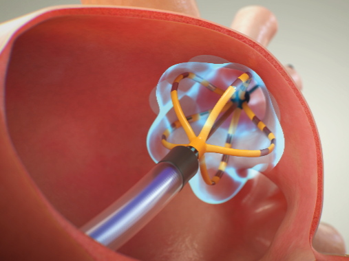 苏州京东方医院成功为房颤患者「消融」除「心病」