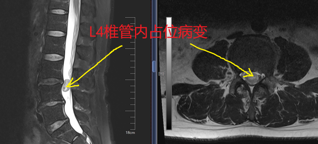 「GPS 导航」定位 精准拆除椎管内肿瘤