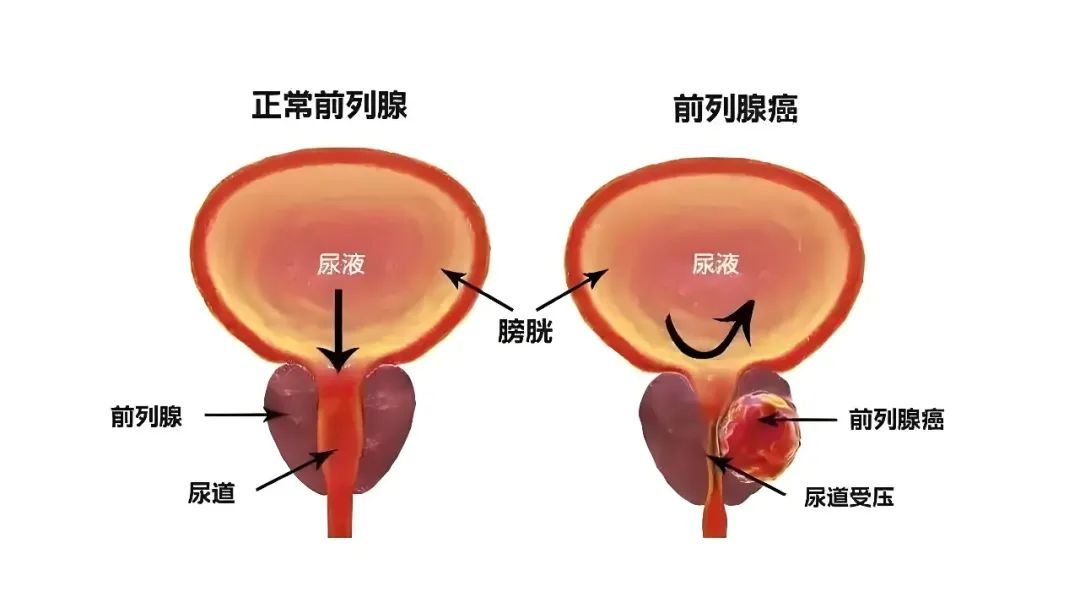 他都躲不过！前列腺癌要关注
