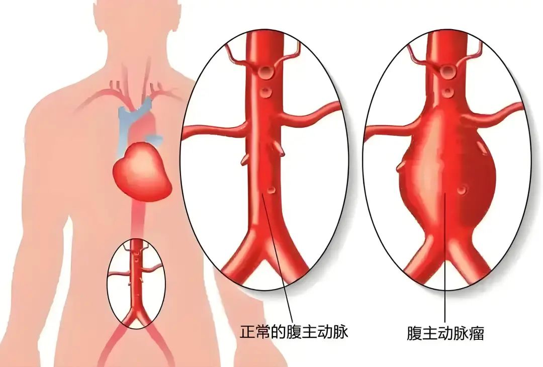 微创拆「弹」！支架巧解腹主动脉瘤危机
