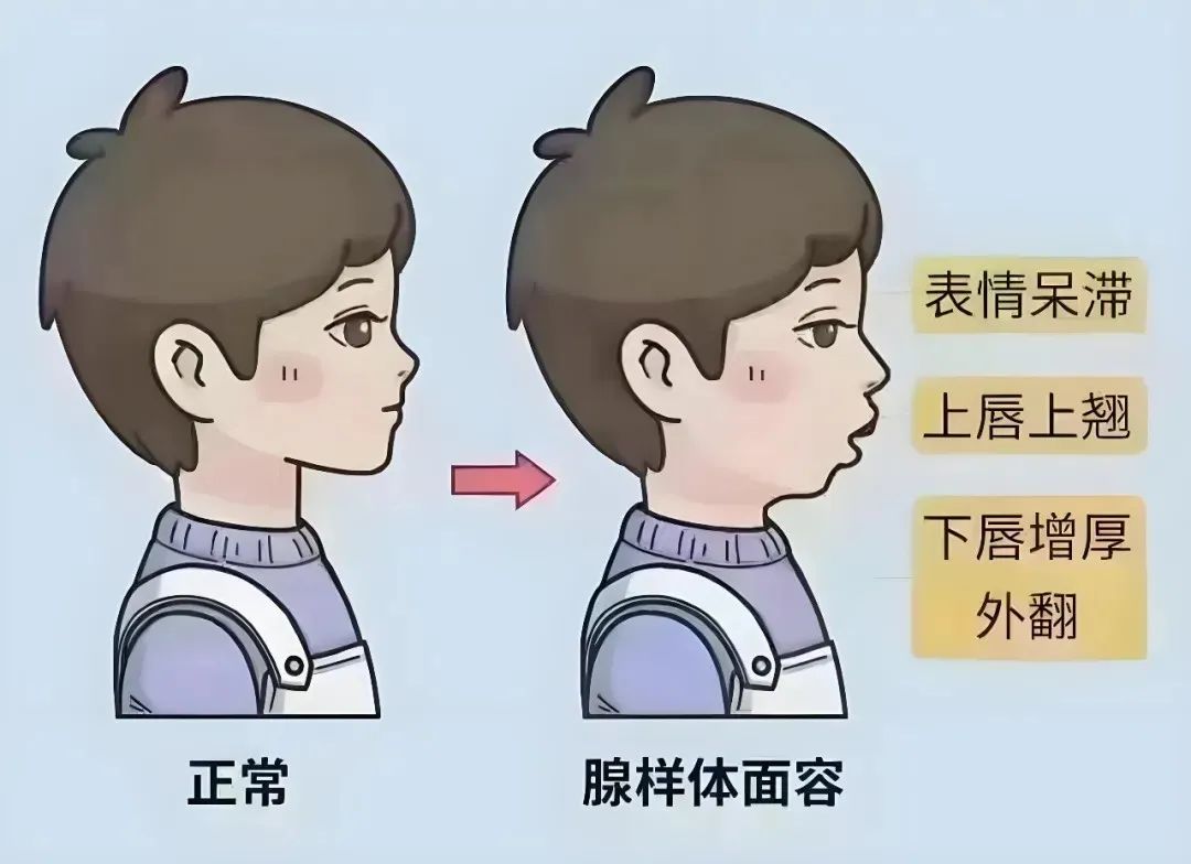 宝宝只能抱着睡？微创手术解难题