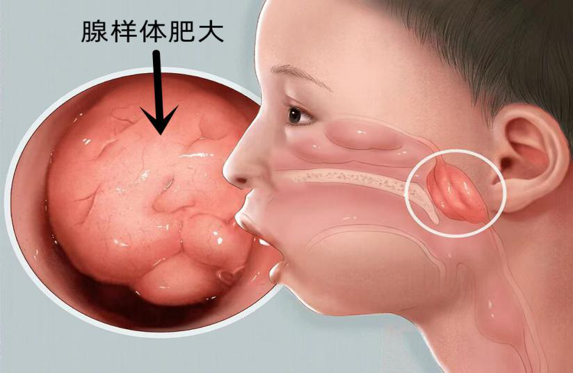 宝宝只能抱着睡？微创手术解难题
