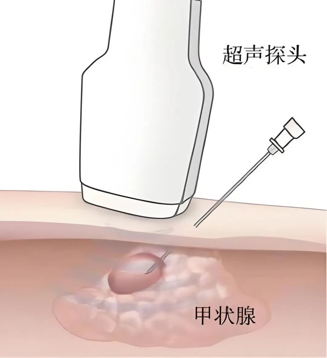 一根细针「烫死」甲状腺结节