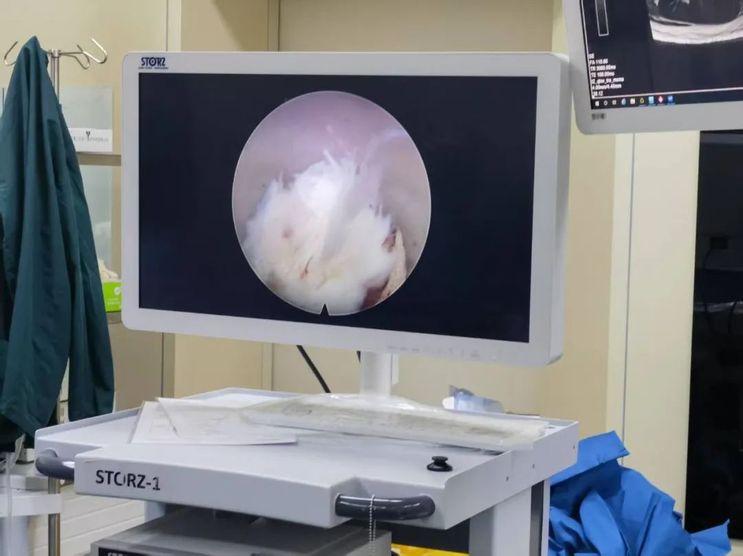 7 毫米！ 「抽」走腰痛病灶