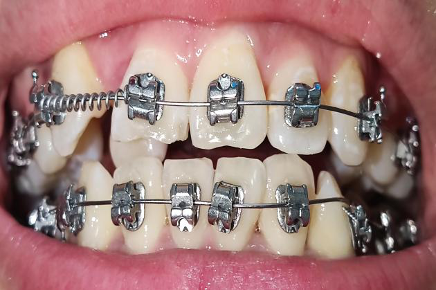 正畸博士后札记:关于孩子颌骨的三个真相