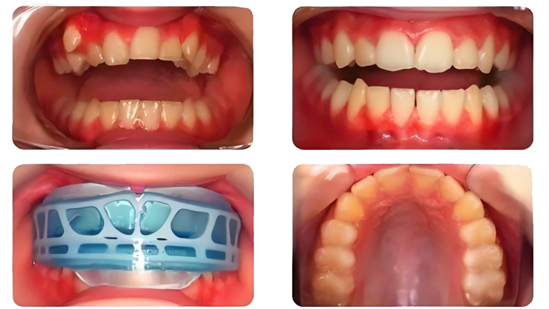 正畸博士后札记:关于孩子颌骨的三个真相