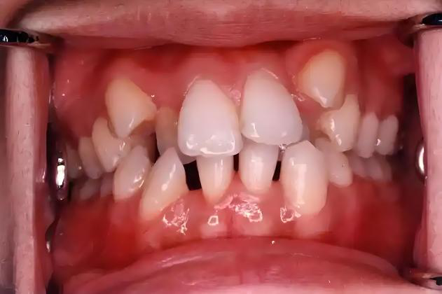 正畸博士后札记:关于孩子颌骨的三个真相