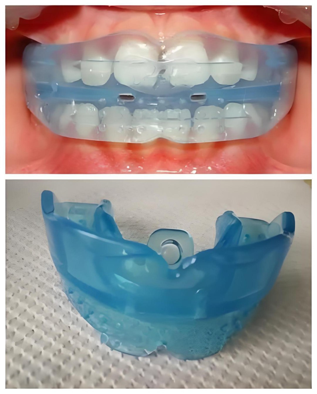 正畸博士后札记:关于孩子颌骨的三个真相