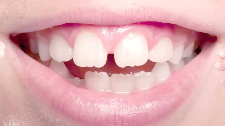 正畸博士后札记:关于孩子颌骨的三个真相