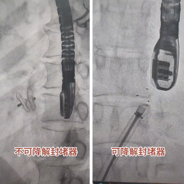 首批 3 例!心脏漏洞无痕修补