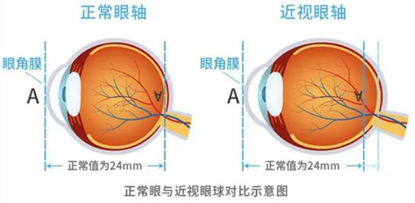 孩子近视年年加深？记住 5 点科学防控
