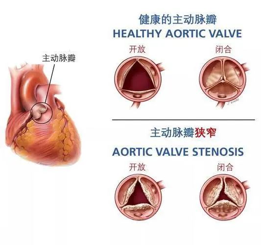 不开胸也能给心脏换瓣！