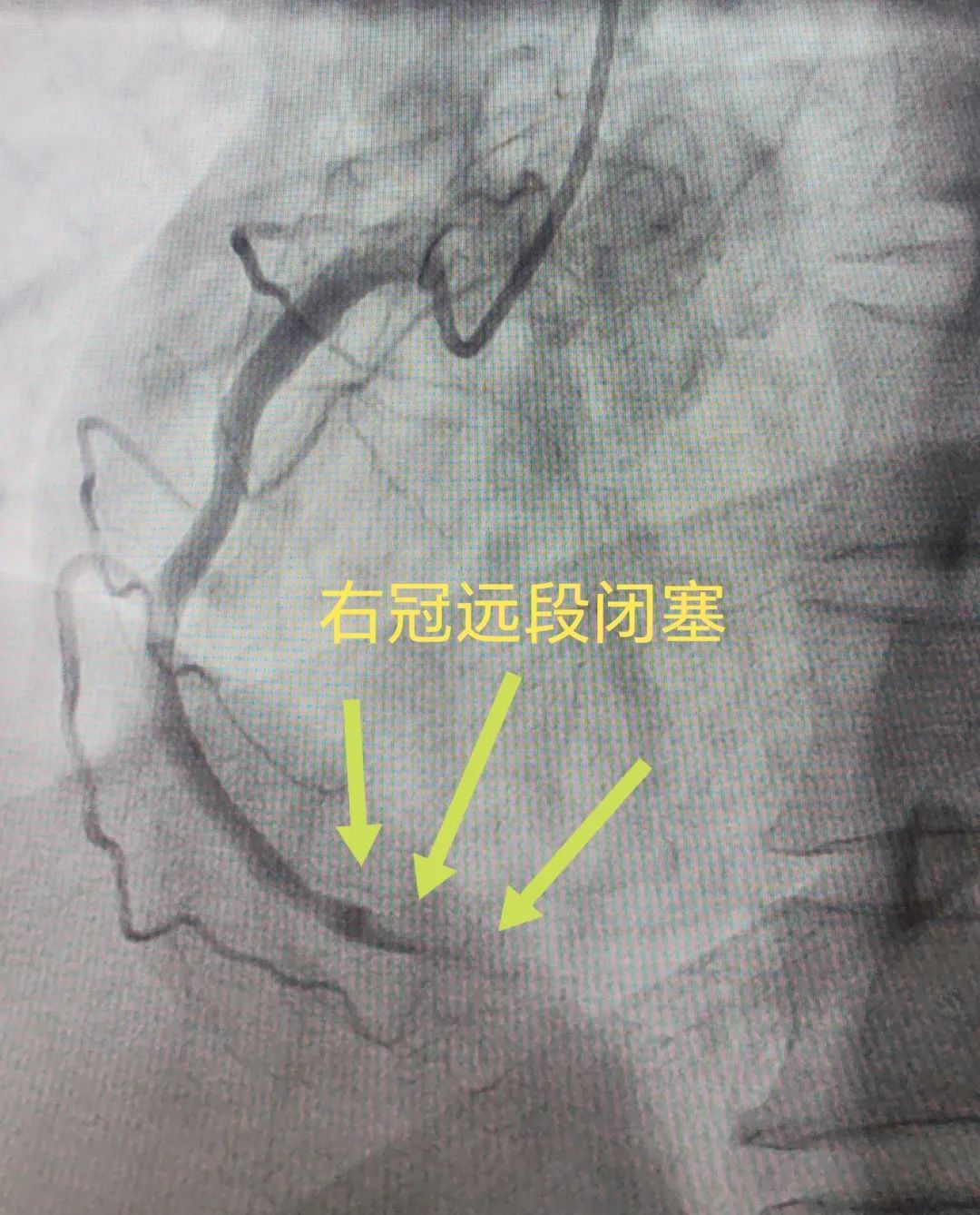 不是胃病是心梗？差点就……
