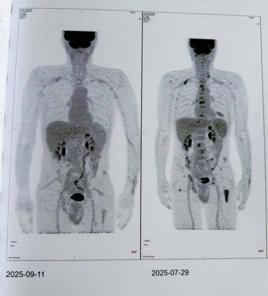 跨越国界的生命守护：陆道培医院 BCMA CAR-T 细胞治疗助力俄罗斯患者实现深度缓解