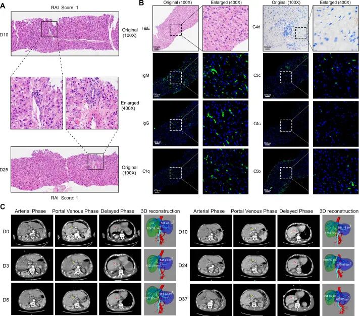 全球首例 | 安徽医科大学实现猪-人活体肝移植，基因编辑供肝存活 171 天