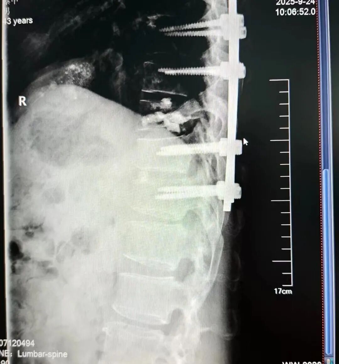 肝癌「啃噬」脊柱，医生往骨头里打「水泥」？