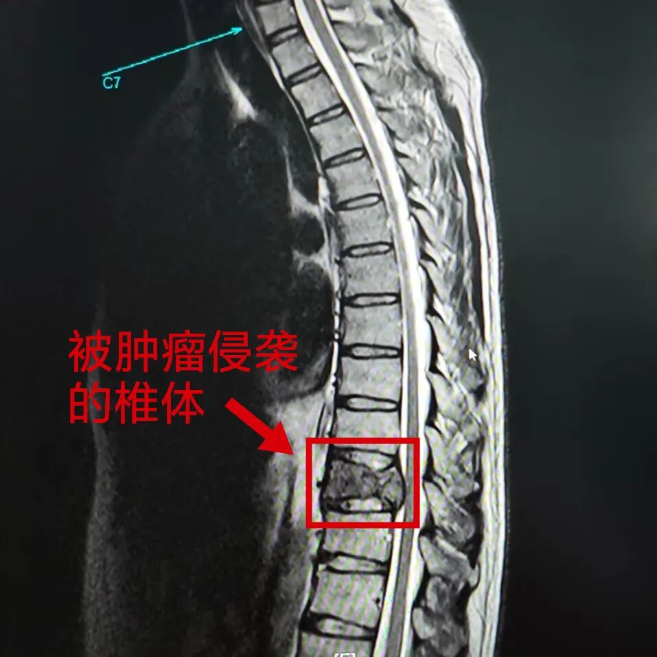 肝癌「啃噬」脊柱，医生往骨头里打「水泥」？