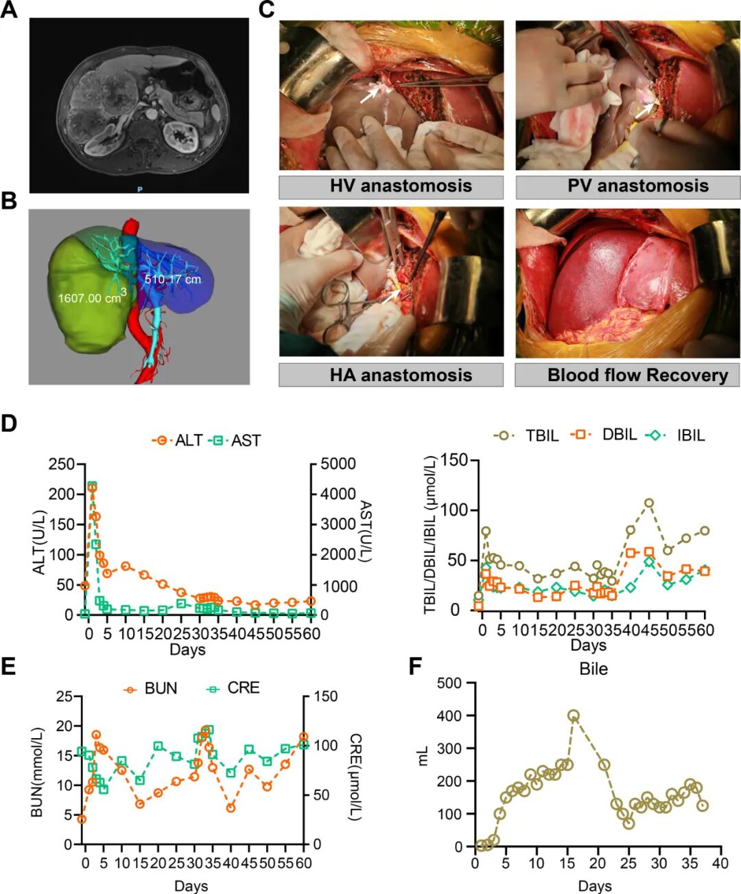 全球首例 | 安徽医科大学实现猪-人活体肝移植，基因编辑供肝存活 171 天