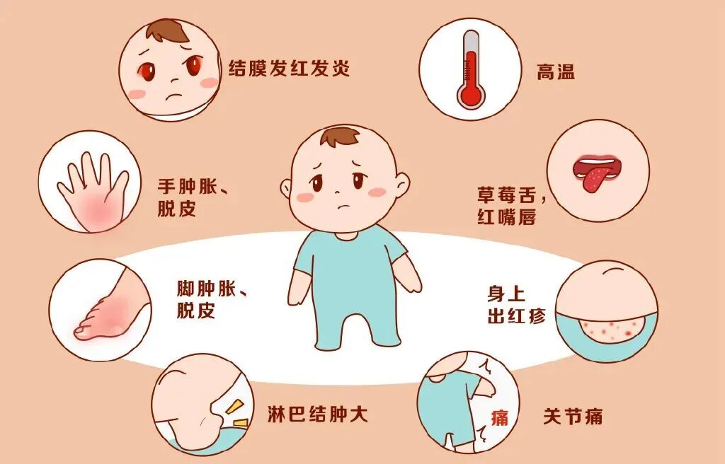 宝宝高烧不退?警惕川崎病!