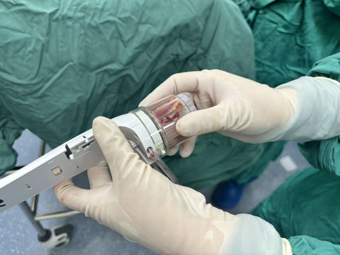 3 毫米针孔「旋」走结节焦虑