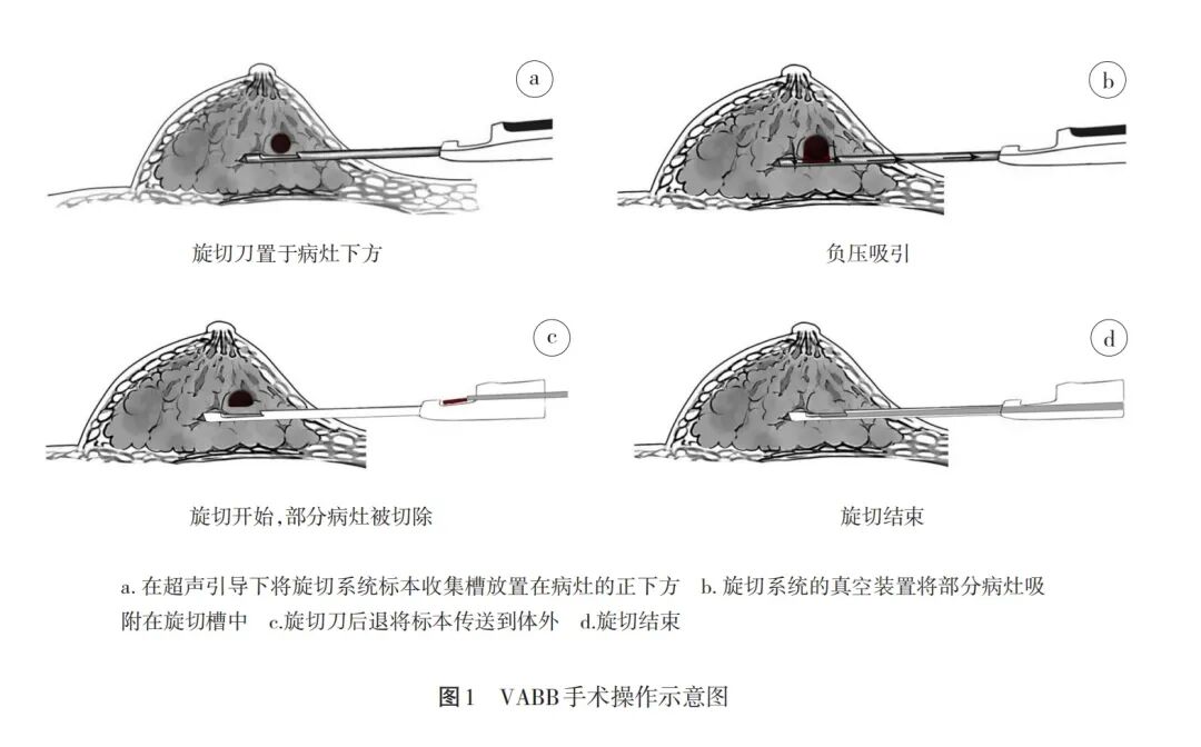 3 毫米针孔「旋」走结节焦虑