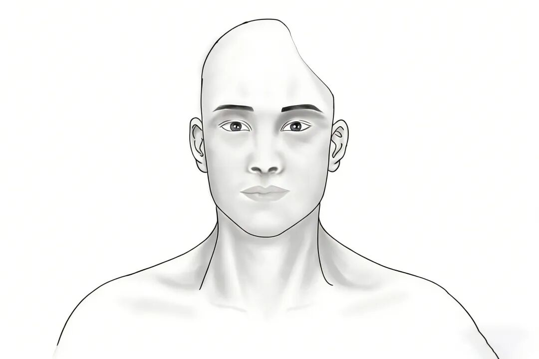 12 cm 颅骨缺口  这样被重塑