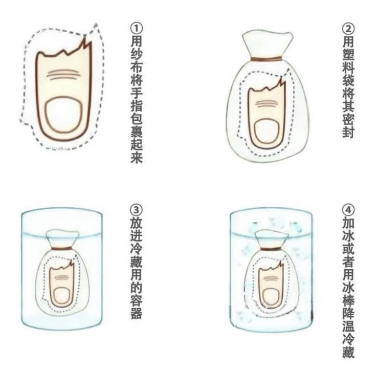 接连多起!骨科断指再植